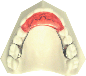 Bite Plate