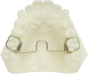 Transpalatal Arch